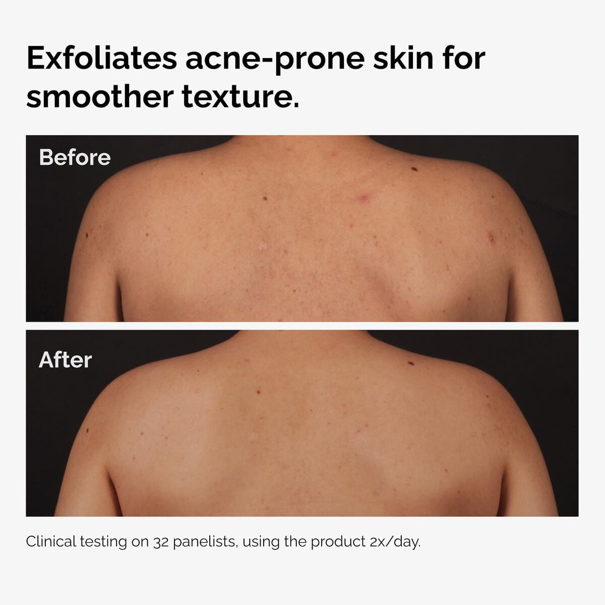 salicylic-acid-0-5-body-serum-m8 ord-salicylic-acid-body-serum-before-after-graphic-NA.jpg