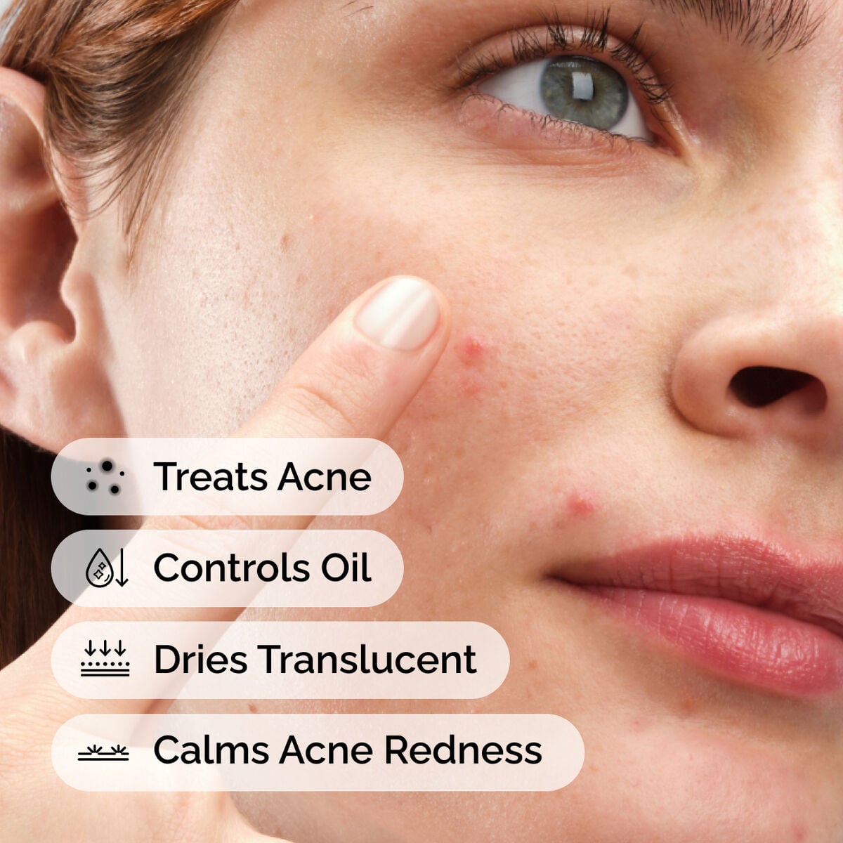 sulfur-10-powder-to-cream-concentrate-n1 ord-sulfur-10pct-powder-to-cream-concentrate-model-application-with-benefits-acne.jpg