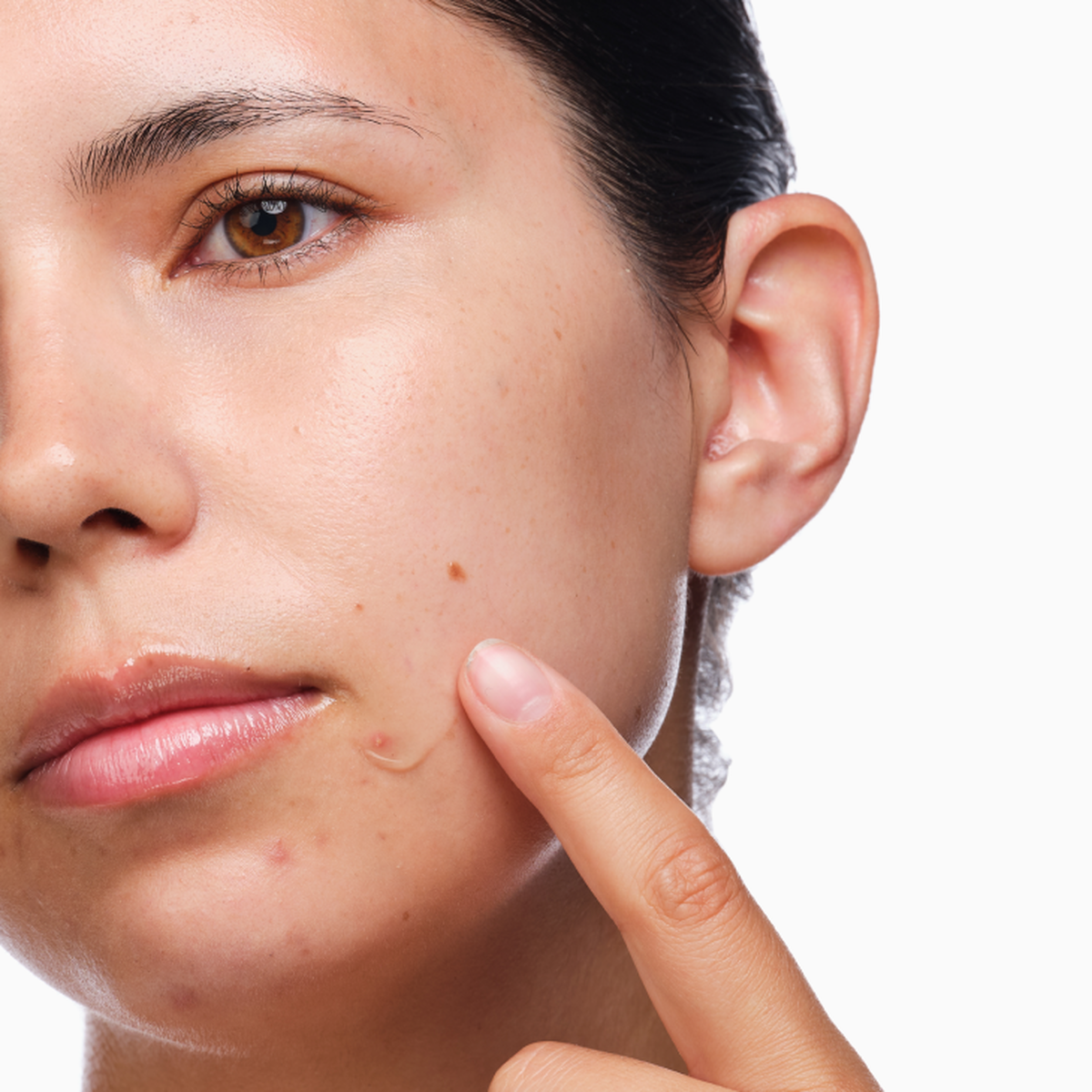 the-acne-set-g2 rdn-the-acne-set-application.png